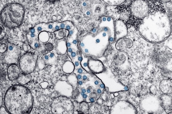 Unikátní a velmi detailní mikroskopický snímek vzorku s nákazou Covid 19
